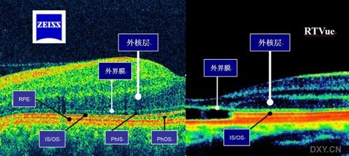 眼底病讨论高清晰oct图片