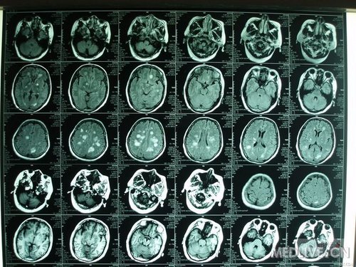 脑白质多发病变_小儿内科