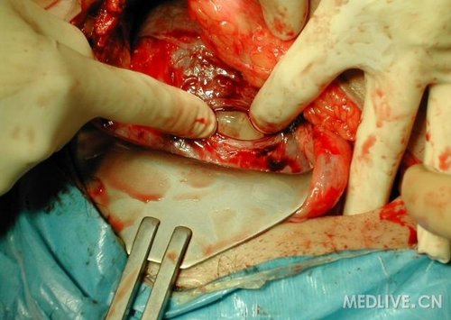 一组高清晰的剖腹产手术全过程照片
