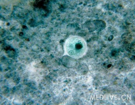 http://webres.medlive.cn/upload/000/012/656