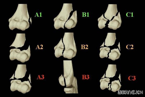 骨折ao分型原则及各种分型图片_骨科