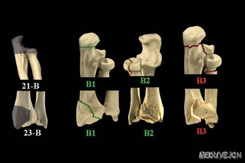 骨折ao分型原则及各种分型图片_骨科