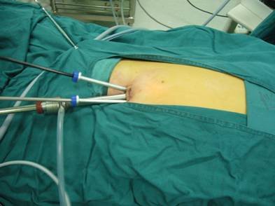 关于腹腔镜在泌尿外科的应用进展的专升本毕业论文范文