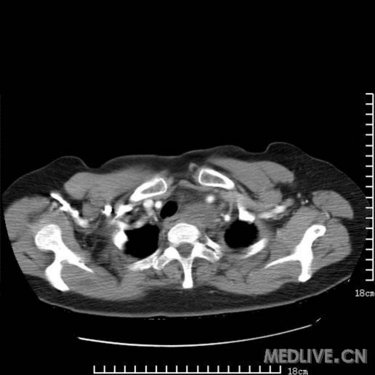 是胸腺瘤?畸胎瘤?高手支招_影像医学和核医学