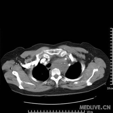 是胸腺瘤?畸胎瘤?高手支招_影像医学和核医学