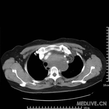 是胸腺瘤?畸胎瘤?高手支招_影像医学和核医学