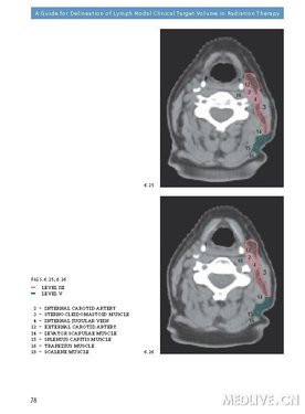 放疗靶区勾画指南之--头颈淋巴结_肿瘤科圈子