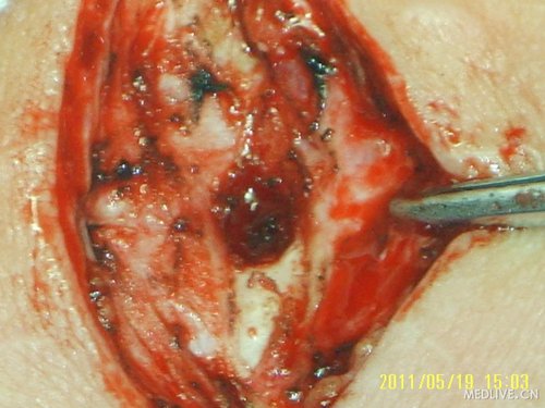 1例少见的切口感染病例,与大家共享!