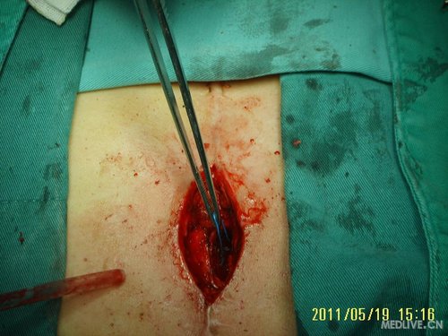 1例少见的切口感染病例,与大家共享!