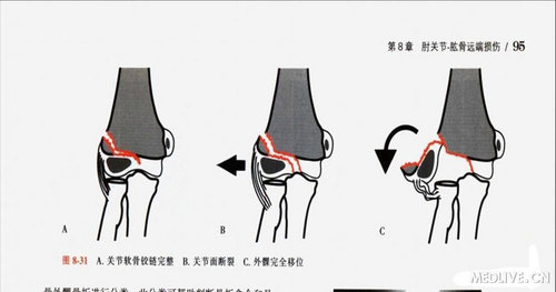 肱骨小头及滑车骨折你见过多少