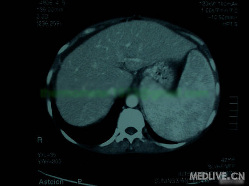 【病例讨论】一个奇怪的病例分析,请加大踊跃
