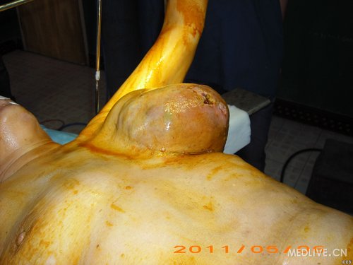 巨大乳腺肿瘤手术过程(图片)_<em>妇产科</em>_医脉通