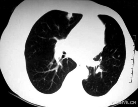 反复发热、咳嗽、咳痰1年余,气短8个月,加重4