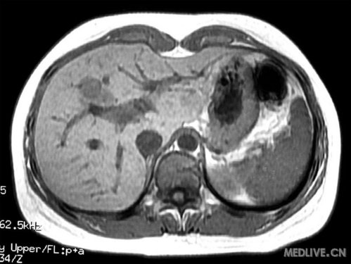 体检发现肝占位2个月余--上海中山医院病例_肿