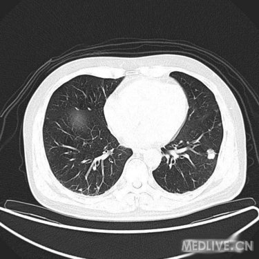 【影像读片】两肺多发性结节---罕见病例,长见