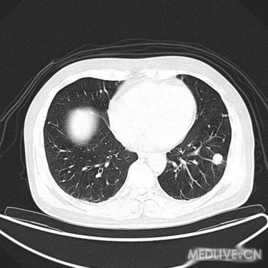 【影像读片】两肺多发性结节---罕见病例,长见