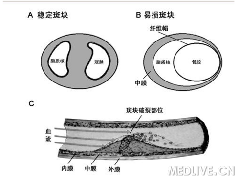 脂质坏死的核心大,常占斑块体积的40%以上,其纤维帽薄而弱,易受损伤