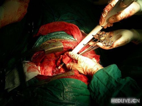冠心病合并食管癌同一切口手术_圈子_医脉通