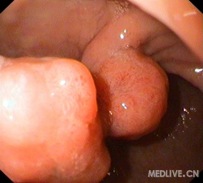 http://webres.medlive.cn/upload/000/038/331
