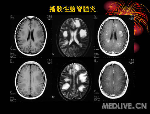 肿瘤样脱髓鞘病变影像特征以及鉴别诊断