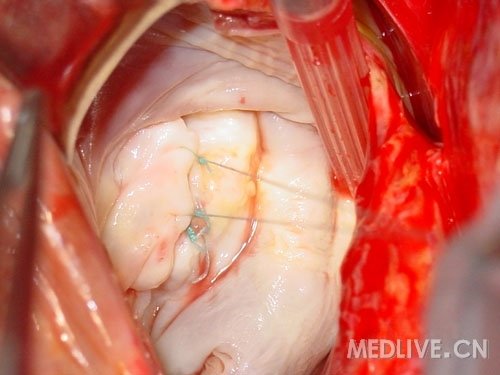 http://webres.medlive.cn/upload/000/053/142