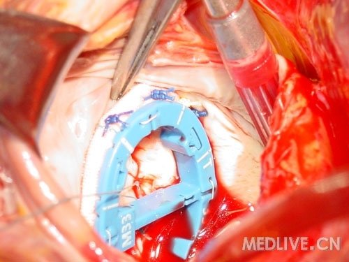 http://webres.medlive.cn/upload/000/053/145
