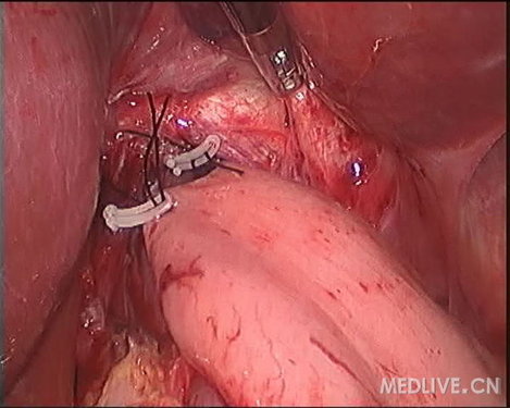 http://webres.medlive.cn/upload/000/060/828