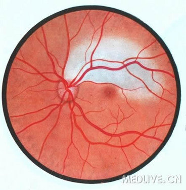 点击查看原图 http://webres.medlive.cn/upload/000/061/051
