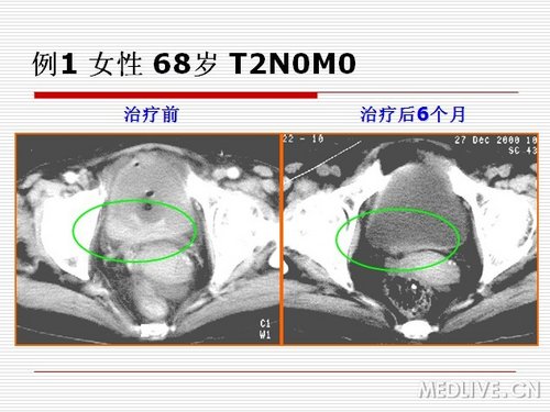 【课件】立体定向放疗在膀胱癌治疗中的价值_