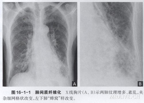 寻常性间质性肺炎\/特发性肺纤维化_呵呵4的日