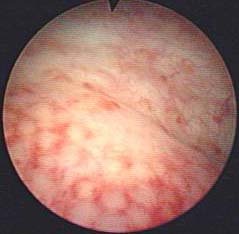 【每日一病】腺性膀胱炎_泌尿外科阵营_泌尿