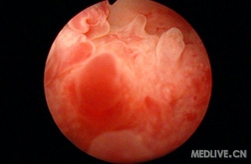 【每日一病】腺性膀胱炎_泌尿外科阵营_泌尿