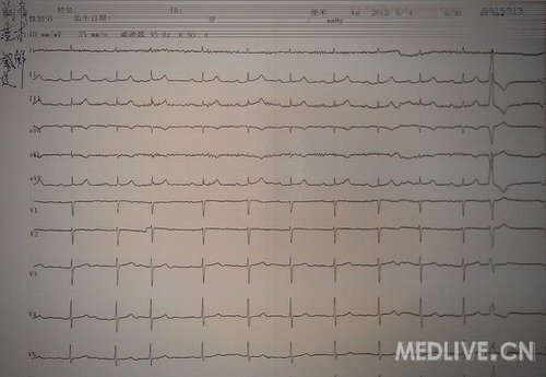 一个典型痉挛性心绞痛心电图动态变化过程_心