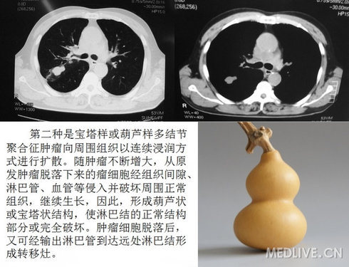 【讲座】医学影像征象解析汇集(呼吸系统)