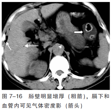 缺血性肠病和肠结核ct诊断要点 医脉通消化科 微信公众号文章阅读 Wemp