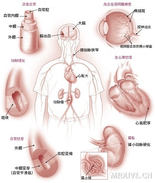 高血压靶器官受累图,清晰明了