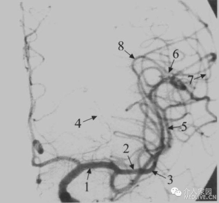 大脑中动脉分段详解(经典简图 dsa)