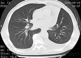 肺内胸腺瘤1例