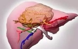 磁共振介入在肝细胞癌治疗中的应用