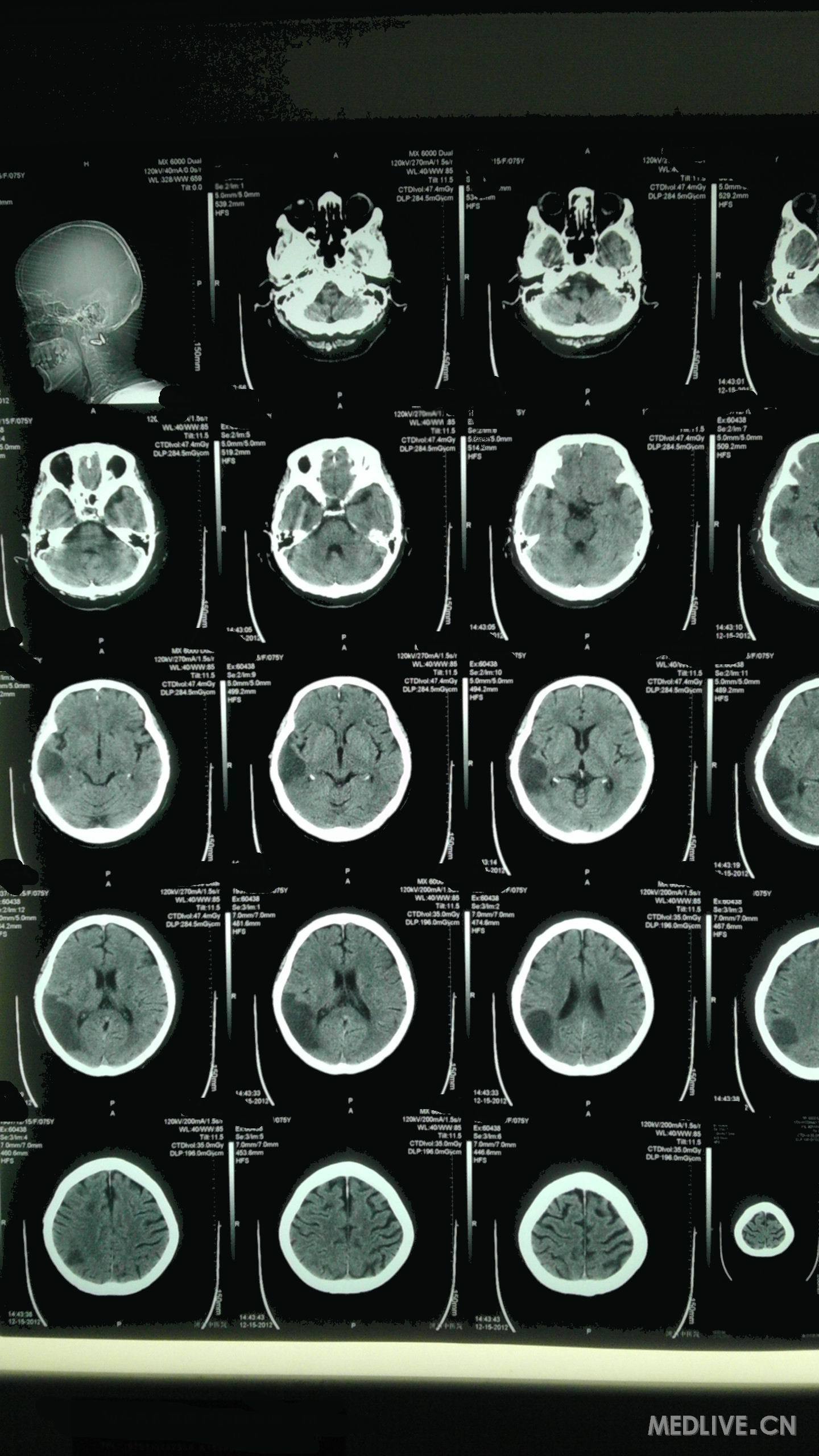 脑CT片子图片