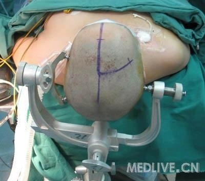 开颅手术真实记录有图