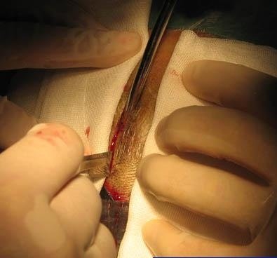 蛛网膜开颅手术图片图片