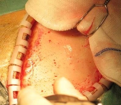 开颅手术真实记录有图