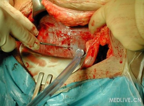一组高清晰的剖腹产手术全过程照片
