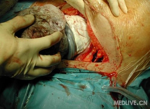 一组高清晰的剖腹产手术全过程照片