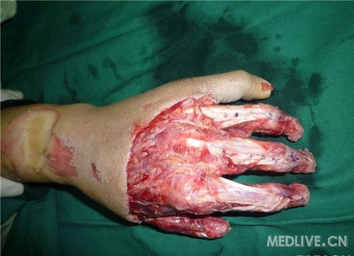 hs病例分析一例头疼的手部脱套伤的治疗过程