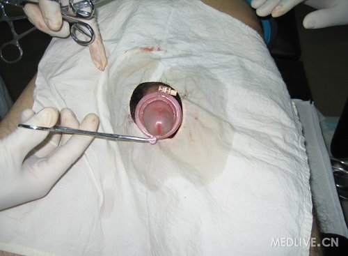 最新包皮环切图谱真实图片