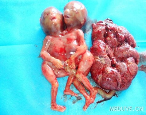 双胎联体胎儿引产图片