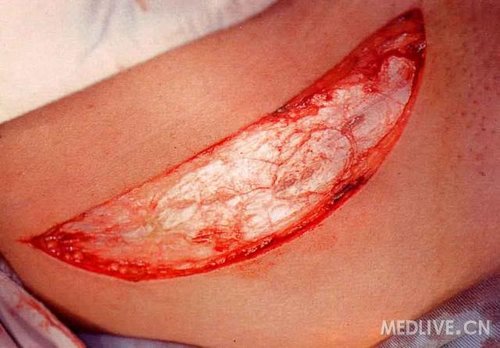 肾移植手术步骤的图片