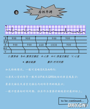 常见心律失常梯形图图例